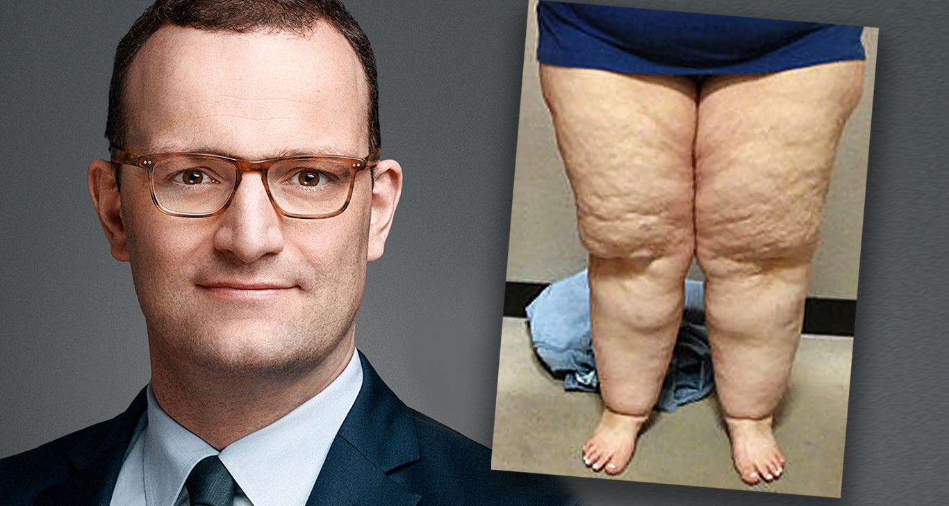 Lipödem Vorher Nachher Gurias glitteri