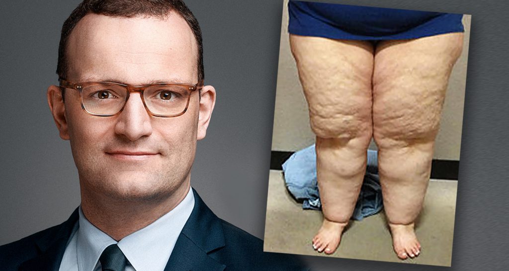 Jens Spahn will medizinisch notwendige FettAbsaugung bei Lipödem zur Kassenleistung machen Jens Spahn will medizinisch notwendige FettAbsaugung bei Lipödem zur Kassenleistung machen